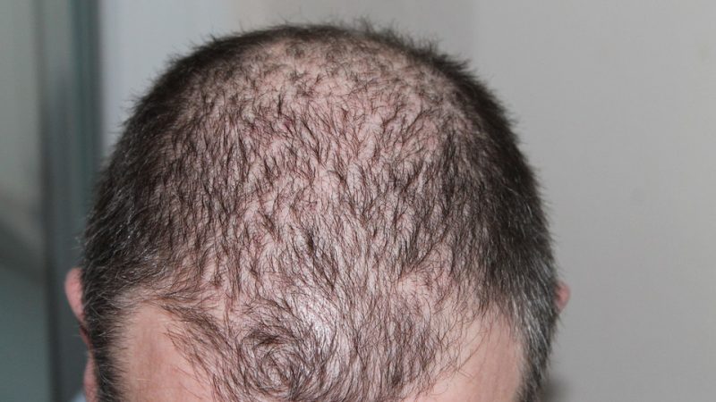 Micropigmentation du cuir chevelu pour homme, qu’est-ce que c’est ?