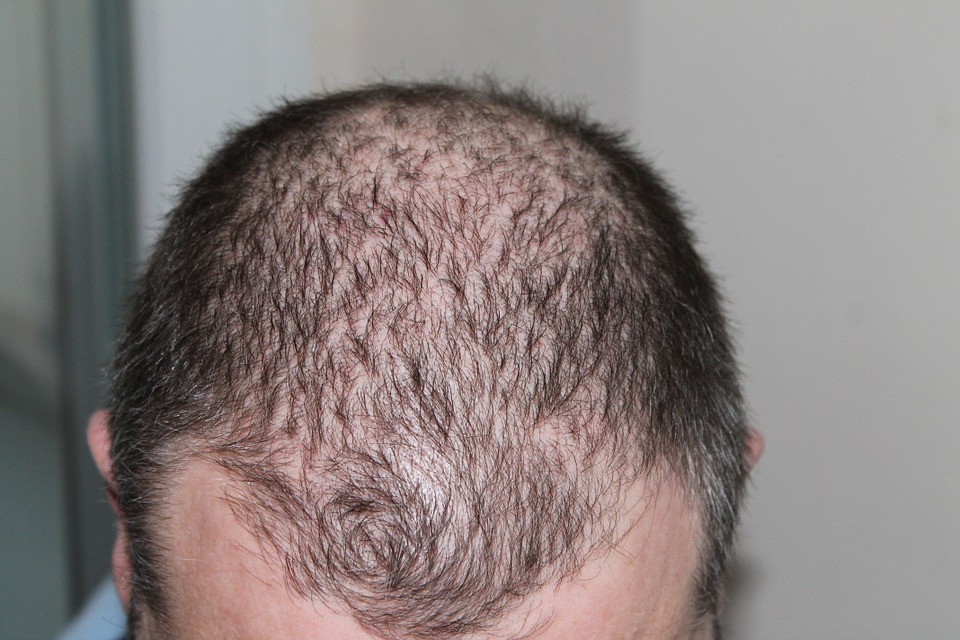 Micropigmentation du cuir chevelu pour homme, qu’est-ce que c’est ?